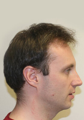 hair transplant before after Photos