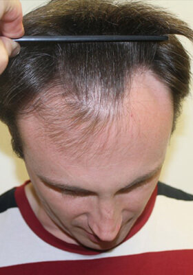 hair transplant photos