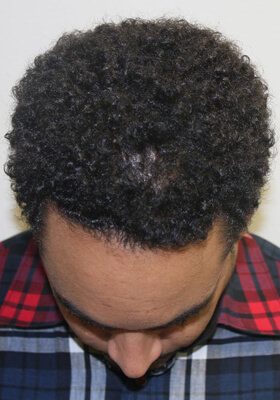 hair transplant photos