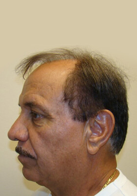 hair transplant photos