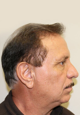 hair transplant photos