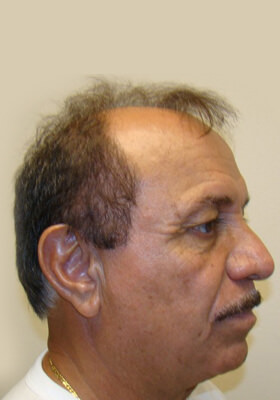 hair transplant photos