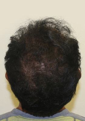 hair transplant before after Photos