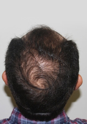 hair transplant photos