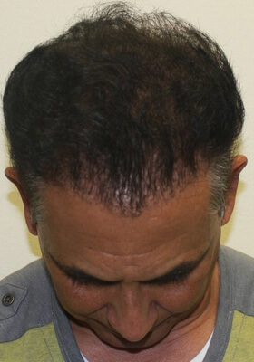 hair transplant photos