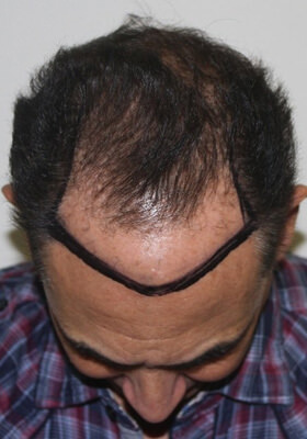 hair transplant photos