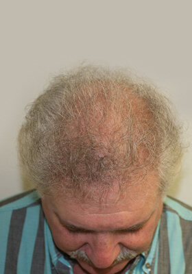 hair transplant before after Photos