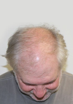 hair transplant photos