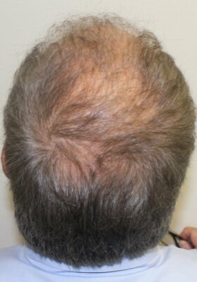 hair transplant photos