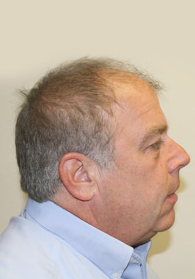 hair transplant photos