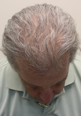 hair transplant photos