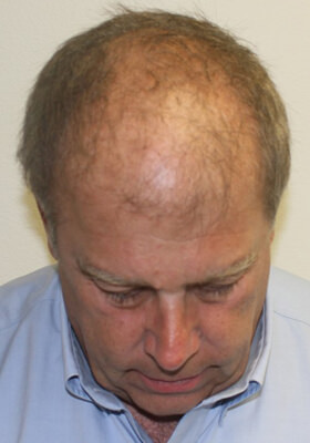 hair transplant photos