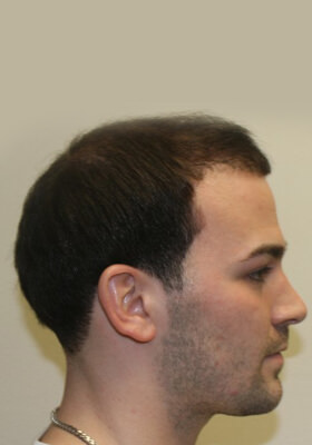 hair transplant before after Photos