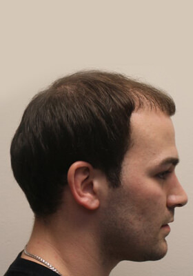 hair transplant photos