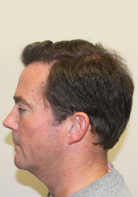 hair transplant photos