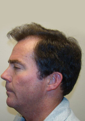 hair transplant before after Photos