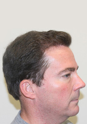 hair transplant photos