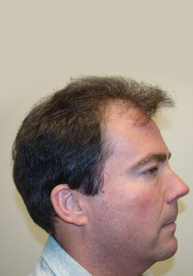 hair transplant photos