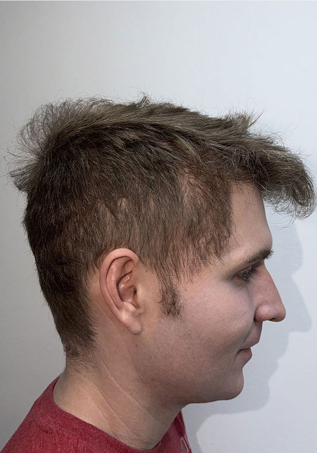 hair transplant before after Photos
