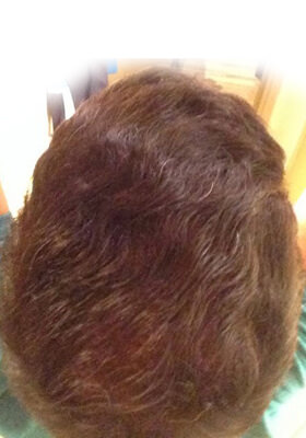 hair transplant photos