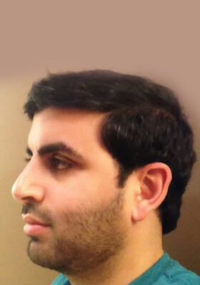 hair transplant photos