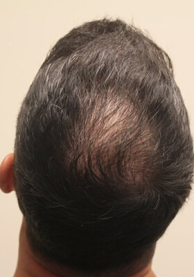 hair transplant before after Photos