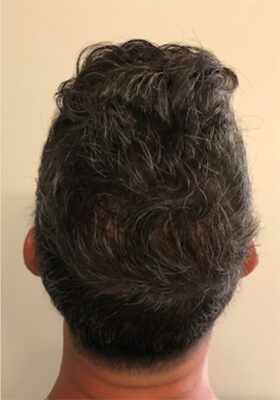 hair transplant photos