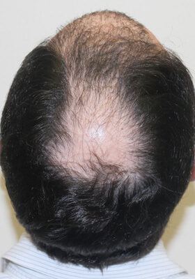 hair transplant photos
