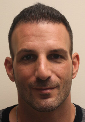 hair transplant before after Photos