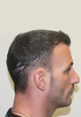 hair transplant photos