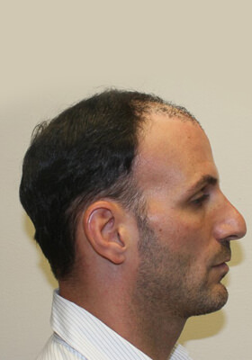 hair transplant before after Photos