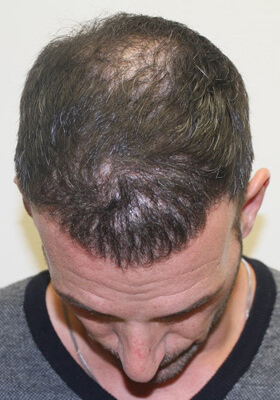 hair transplant photos