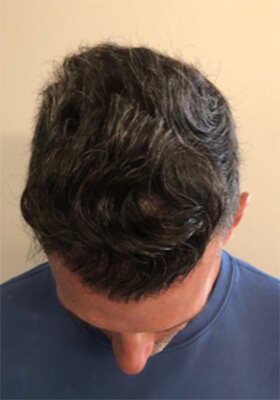 hair transplant photos