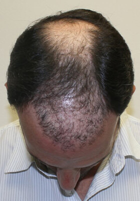 hair transplant before after Photos