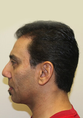 hair transplant before after Photos