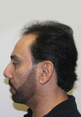 hair transplant before after Photos