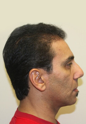 hair transplant before after Photos