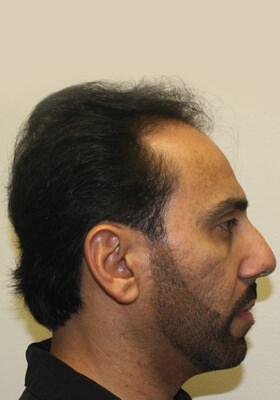 hair transplant before after Photos