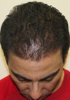 hair transplant photos