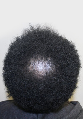 hair transplant photos