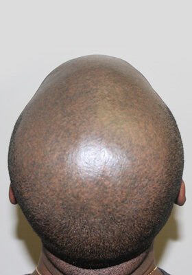 hair transplant before after Photos