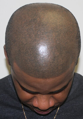 Dr Brett Bolton Patient Testimonial Photos - African American Hair Transplant