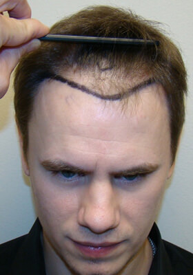 hair transplant before after Photos