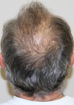 hair transplant photos