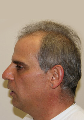 hair transplant photos