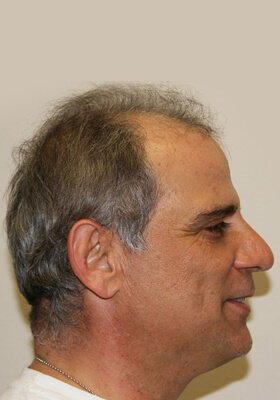 hair transplant photos