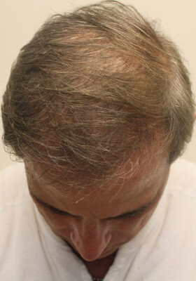 hair transplant photos