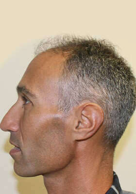 hair transplant photos