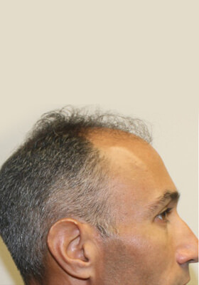 hair transplant before after Photos