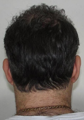 hair transplant before after Photos